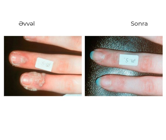 Candela Vbeam Perfecta